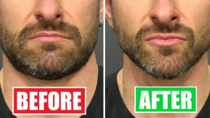 Beneficial Lifestyle Changes for Face Fat Reduction
